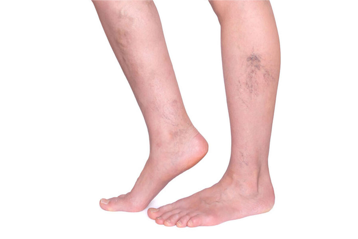 parisi-vene-varicose