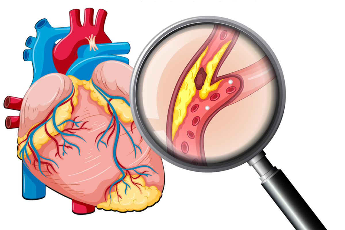 parisi-placche-carotidi-colesterolo